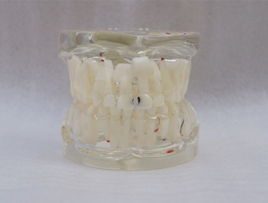 ZM-A12_C11乳恒牙交替帶齲齒