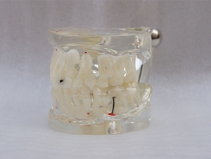 ZM-A12-01_C11乳恒牙交替帶齲齒